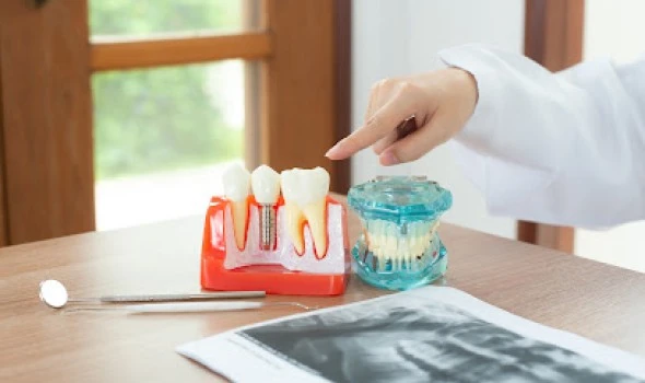 CLILADENT - Clínica Dental La Latina - Implantes Dentales